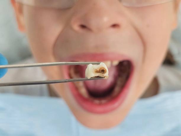 Best Emergency Tooth Extraction in Mansfield, AR