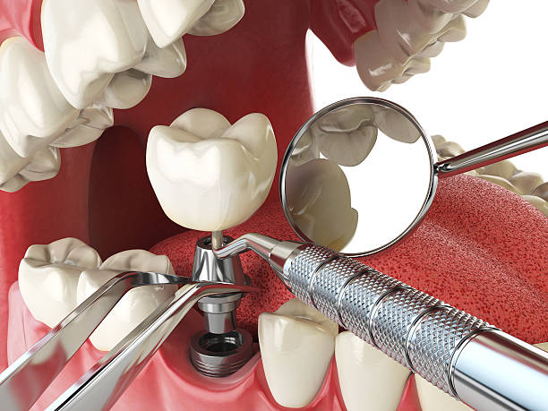 Best Emergency Root Canal Treatment in Mansfield, AR